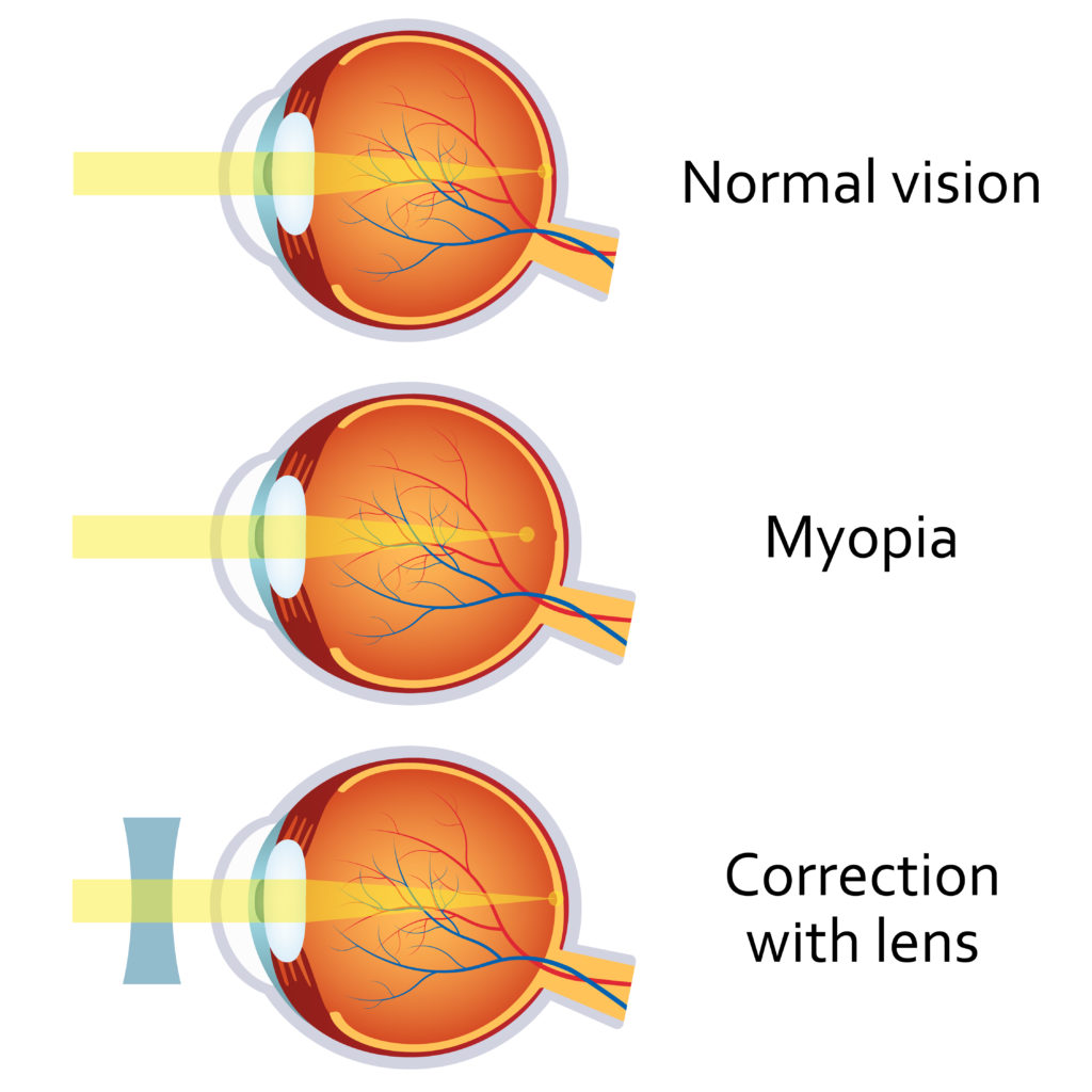 Understanding Refraction And Refractive Errors Eyewa Blog